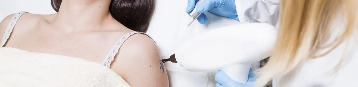 Tattoo Removal | Glenn Dale, MD | Callender Dermatology Tattoo Removal | Glenn Dale, MD | Callender Dermatology