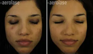 NeoClear Acne Treatment Before & After Photos | Glenn Dale MD NeoClear Acne Treatment Before & After Photos | Glenn Dale MD