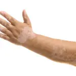 Vitiligo Glenn Dale, MD