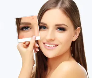 Acne Treatment | Dermatology Glenn Dale, MD Acne Treatment | Dermatology Glenn Dale, MD
