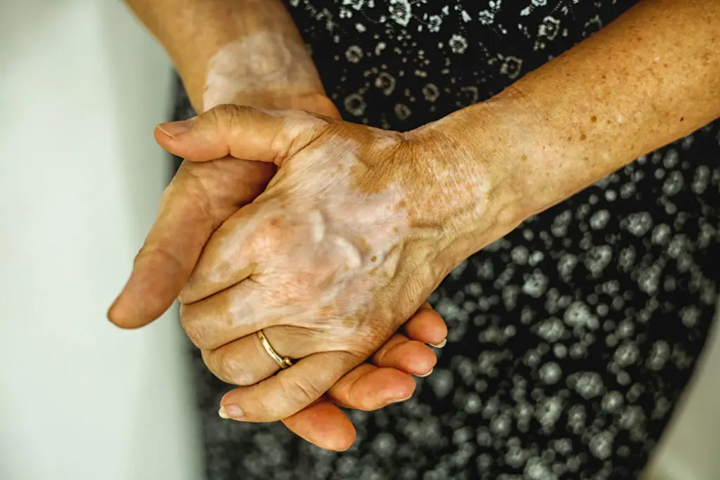 Vitiligo Glenn Dale MD Vitiligo Glenn Dale MD