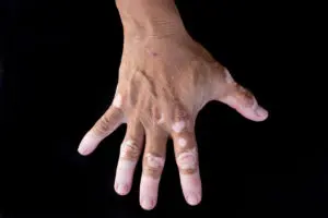 Vitiligo Glenn Dale MD