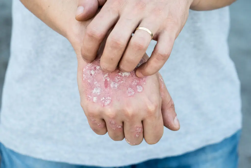 Psoriasis Glenn Dale MD Psoriasis Glenn Dale MD