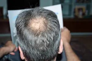 PRP for Hair Loss Glenn Dale MD PRP for Hair Loss Glenn Dale MD