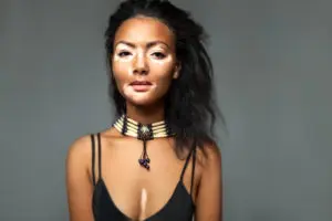 Vitiligo Glenn Dale MD Vitiligo Glenn Dale MD