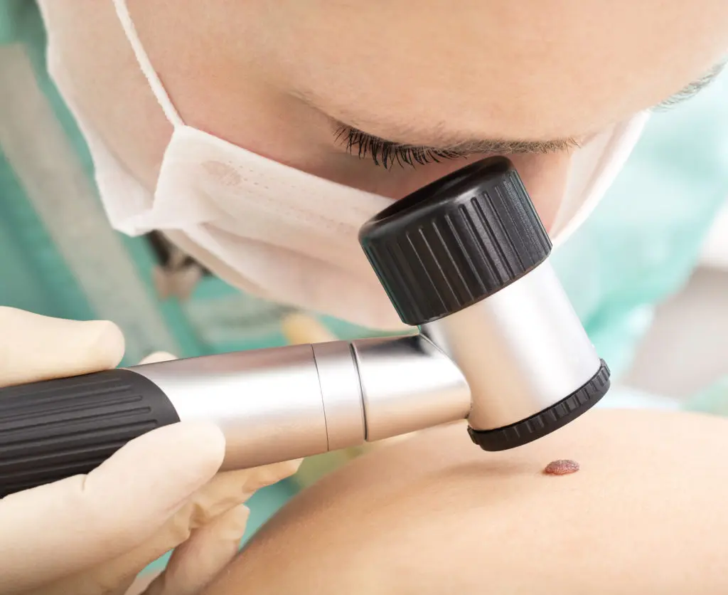 Mole Checkup | Callender Mole Checkup | Callender