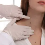 Moles & Birthmarks | Callender