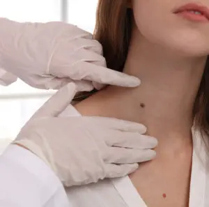 Moles & Birthmarks | Callender Moles & Birthmarks | Callender