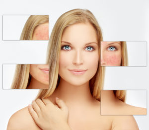 rosacea | glenn dale md