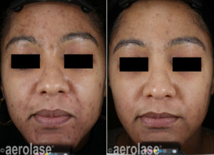 NeoClear Acne Treatment Before & After Photos | Glenn Dale MD