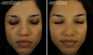 NeoClear Acne Treatment Before & After Photos | Glenn Dale MD