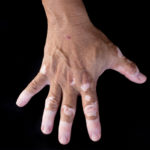 Vitiligo Glenn Dale MD