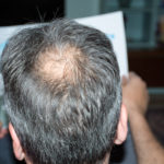 PRP for Hair Loss Glenn Dale MD