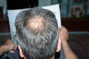 PRP for Hair Loss Glenn Dale MD