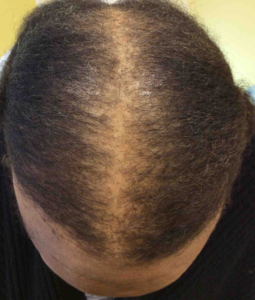 PRP for Hair Loss