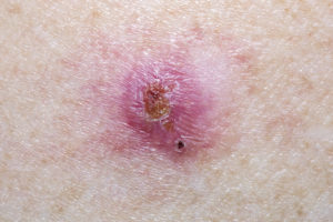 Close-up of a Basal Cell Carcinoma